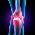 Glucasomine may be an answer for patients with osteoarthritis